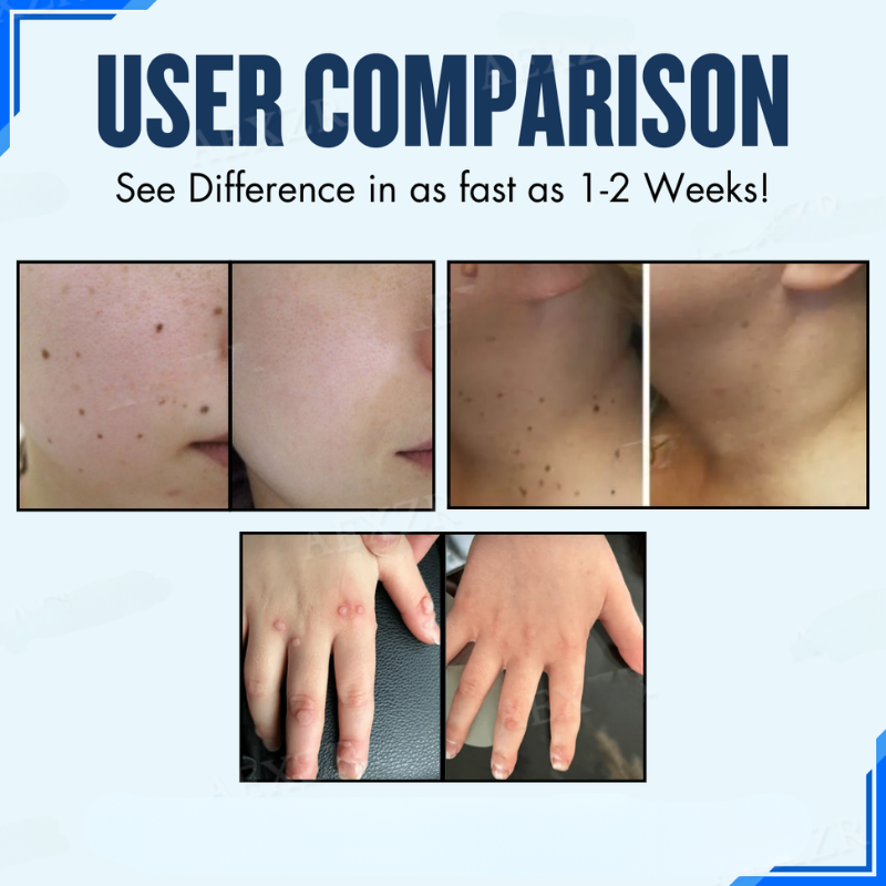 Patch – Effective removal of beauty spots and warts 