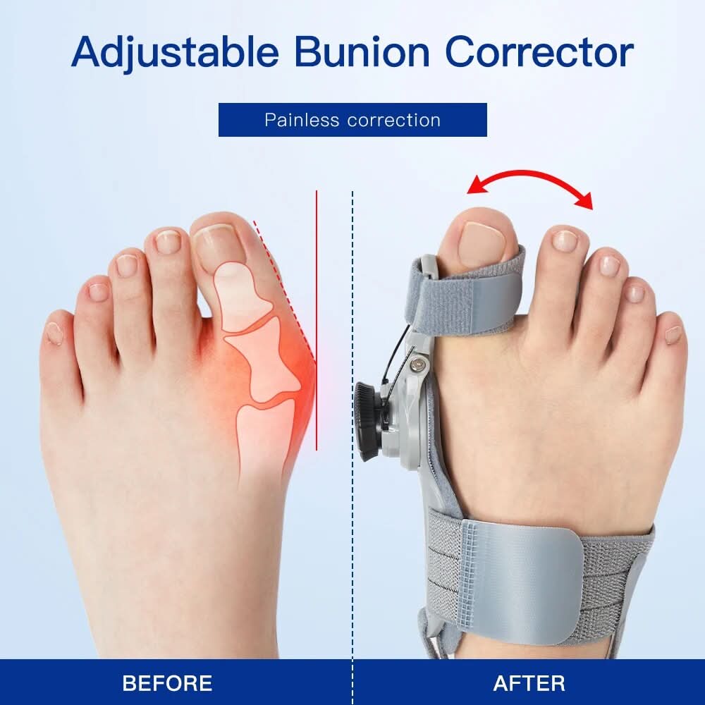 Corrigez vos bunions sans douleur ni opération